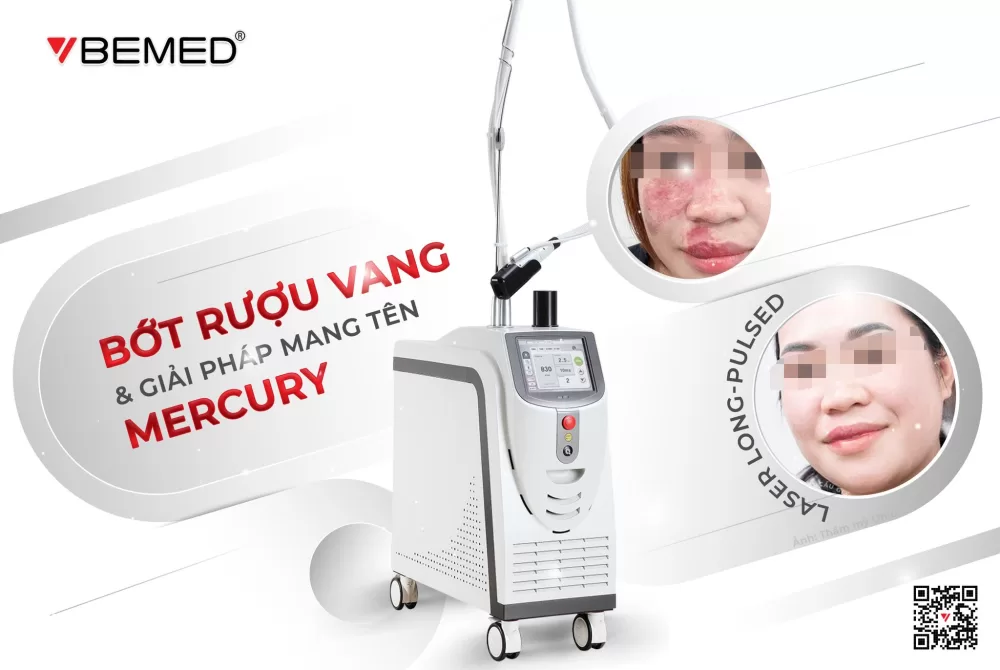 Bớt rượu vang và giải pháp mang tên Mercury