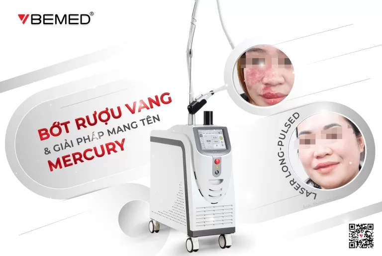 Bớt Rượu Vang Và Giải Pháp Mang Tên Mercury