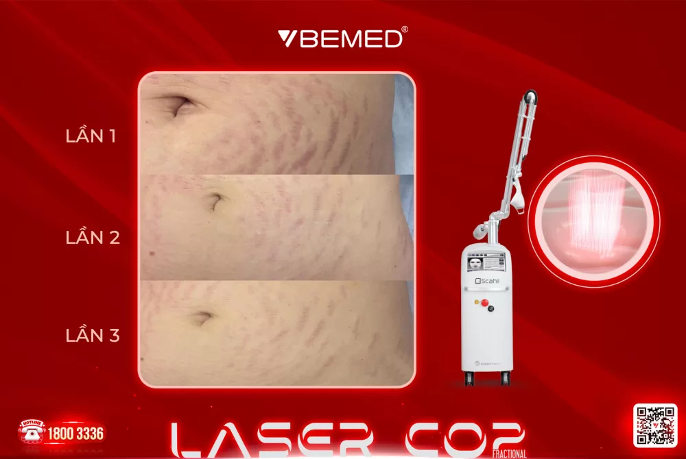 Điều trị rạn da với laser Co2 từ Bemed