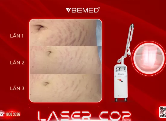 Điều trị rạn da với laser Co2 từ Bemed