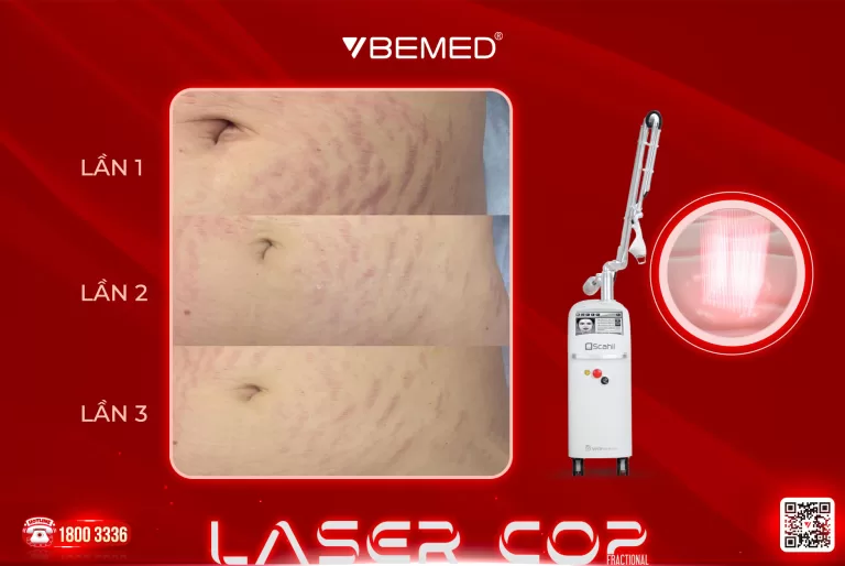 Điều Trị Rạn Da Với Laser CO2 Fractional Thế Hệ Thứ 2