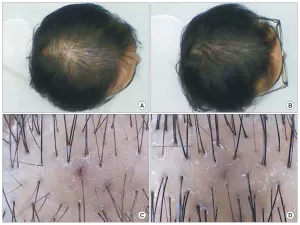 Kết quả điều trị bằng Thulium và PDRN