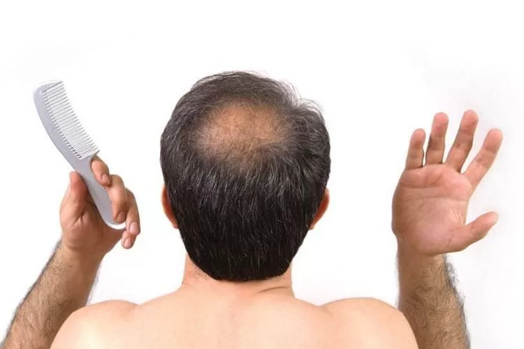 Rụng t&oacute;c nội tiết