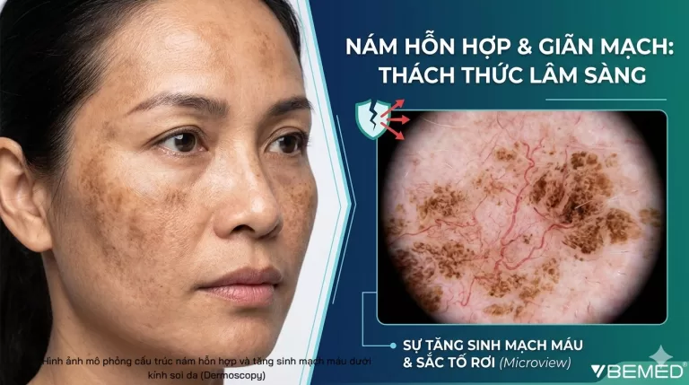 Th&aacute;ch thức trong điều trị c&aacute;c bệnh l&yacute; tăng sắc tố da