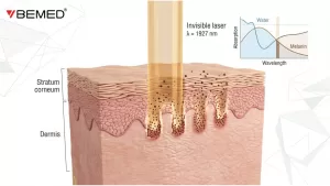 co-che-lavieen-thulium-laser-1927nm-tri-melasma.jpg