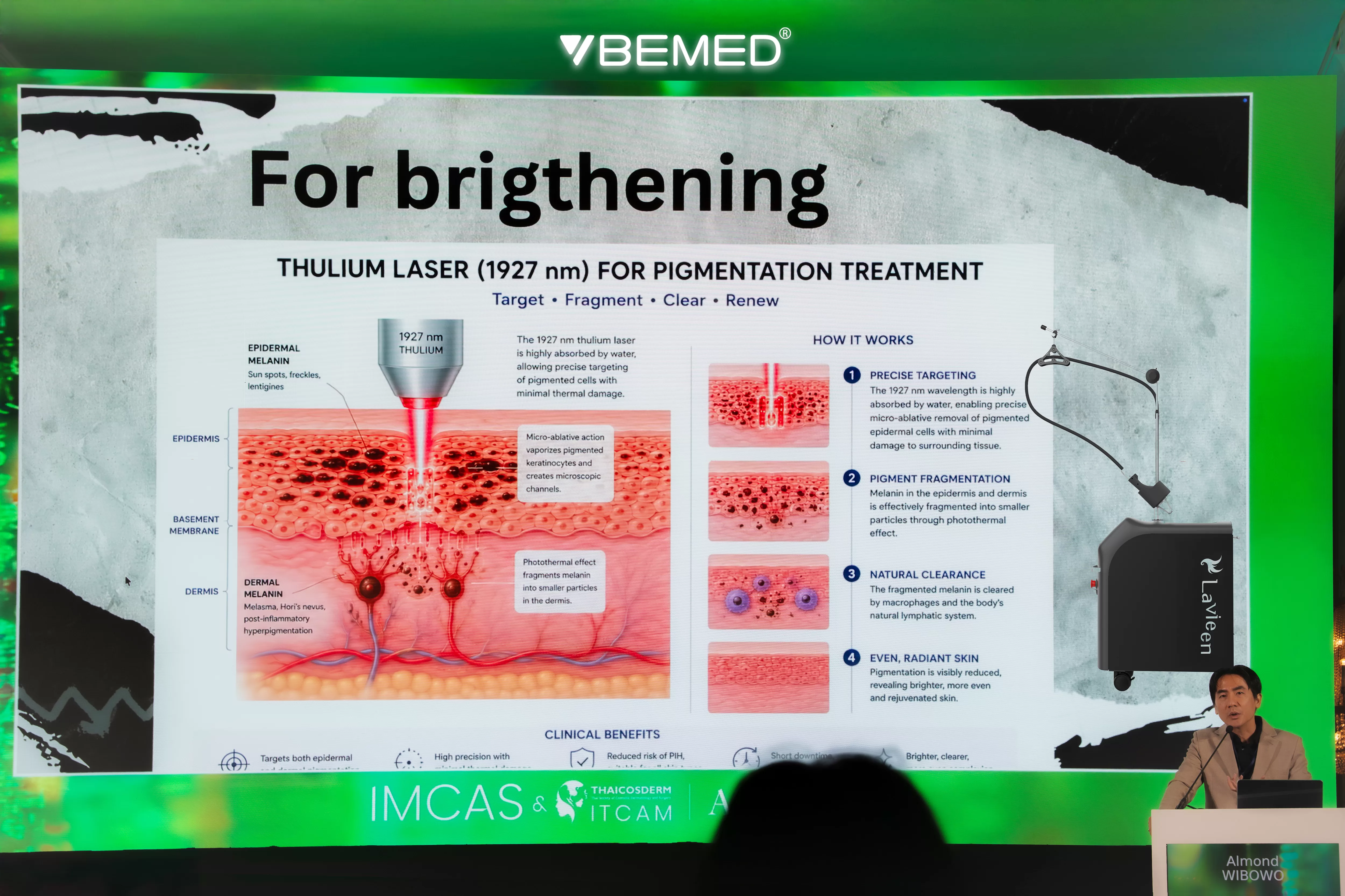 Sơ đồ 4 bước hoạt động của Lavieen Thulium Laser điều trị sắc tố melanin từ m&agrave;ng đ&aacute;y biểu b&igrave; đến thanh thải tự nhi&ecirc;n.